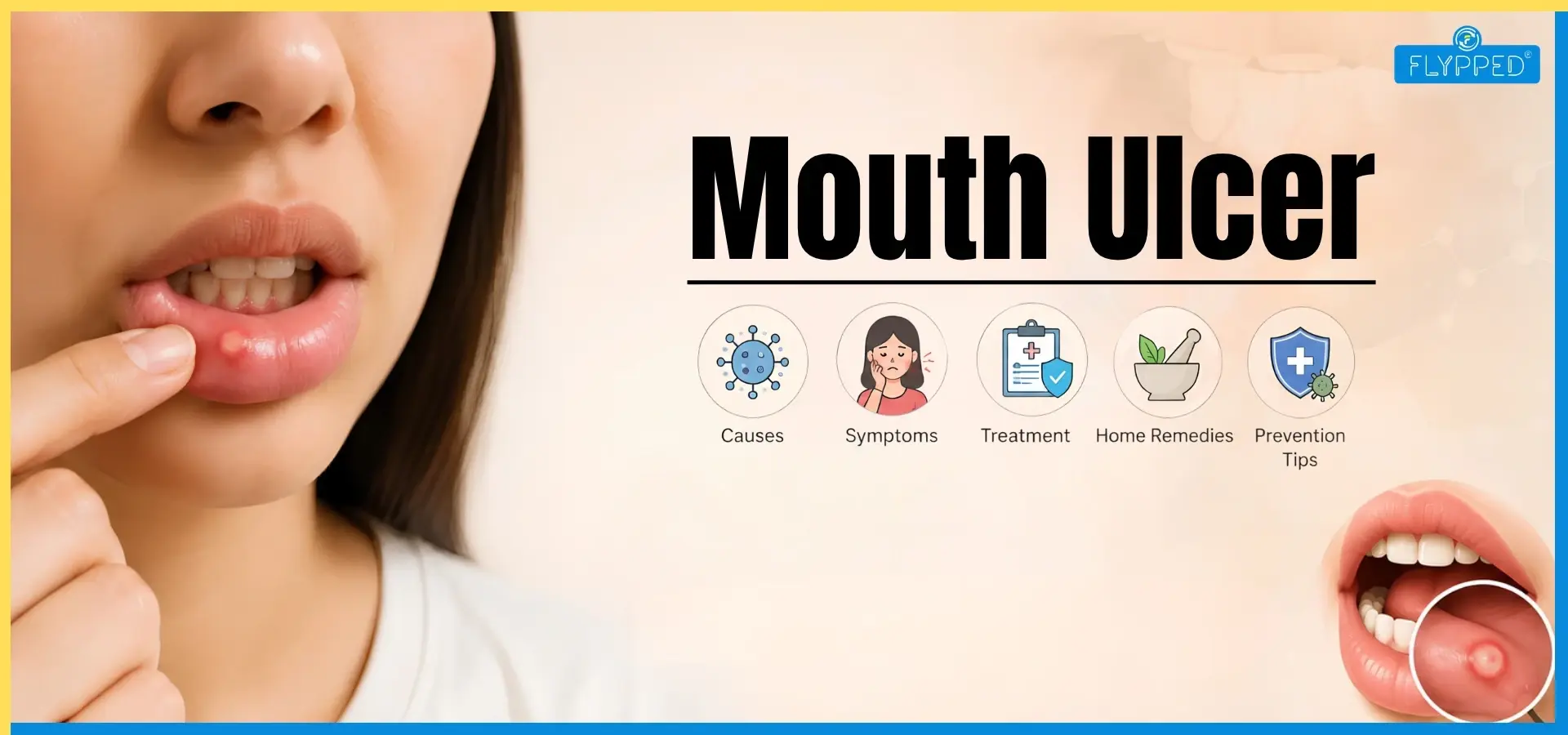 Mouth Ulcer: Causes, Symptoms, Treatment, Home Remedies and Prevention Tips