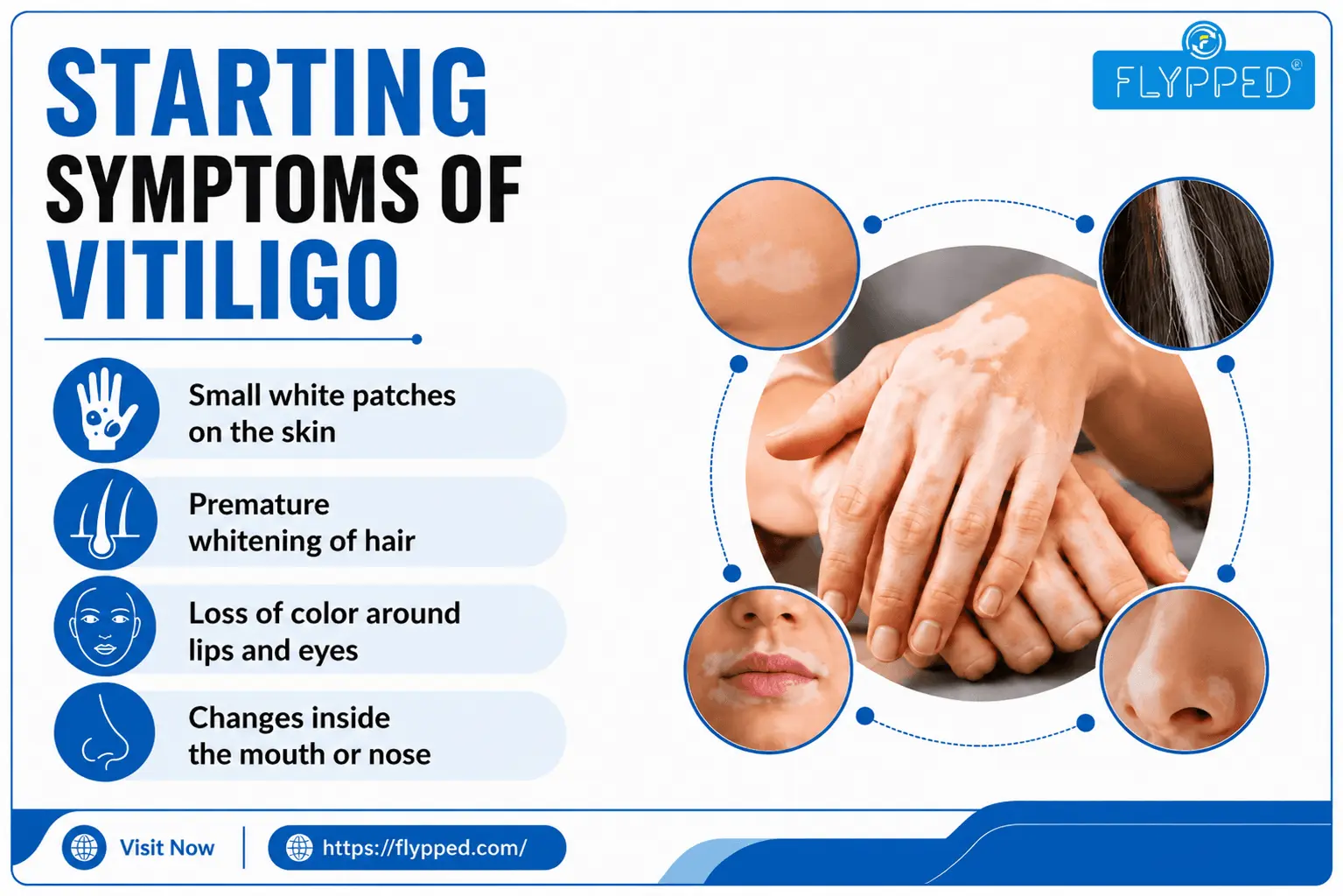 Starting Symptoms of Vitiligo