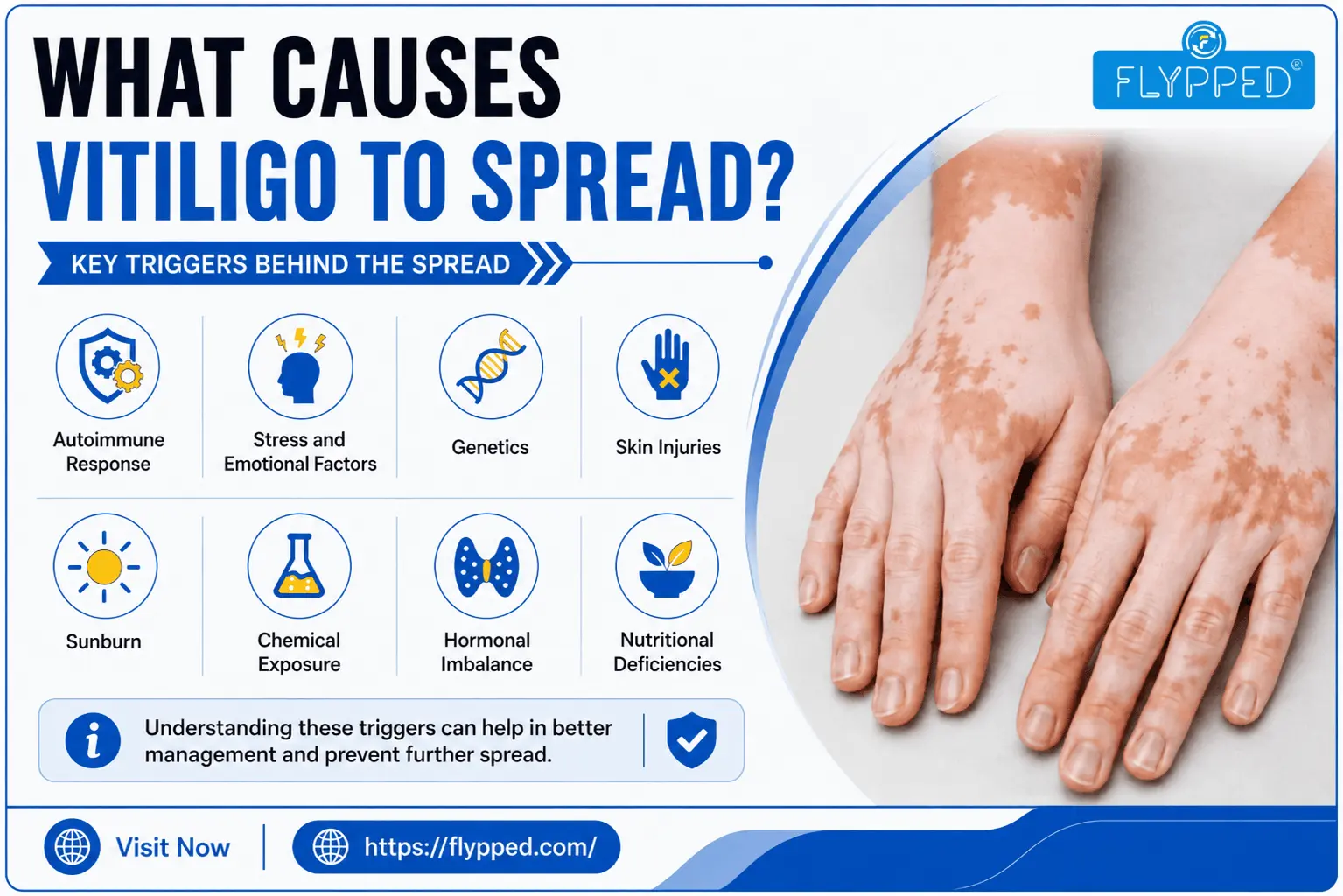 What Causes Vitiligo to Spread