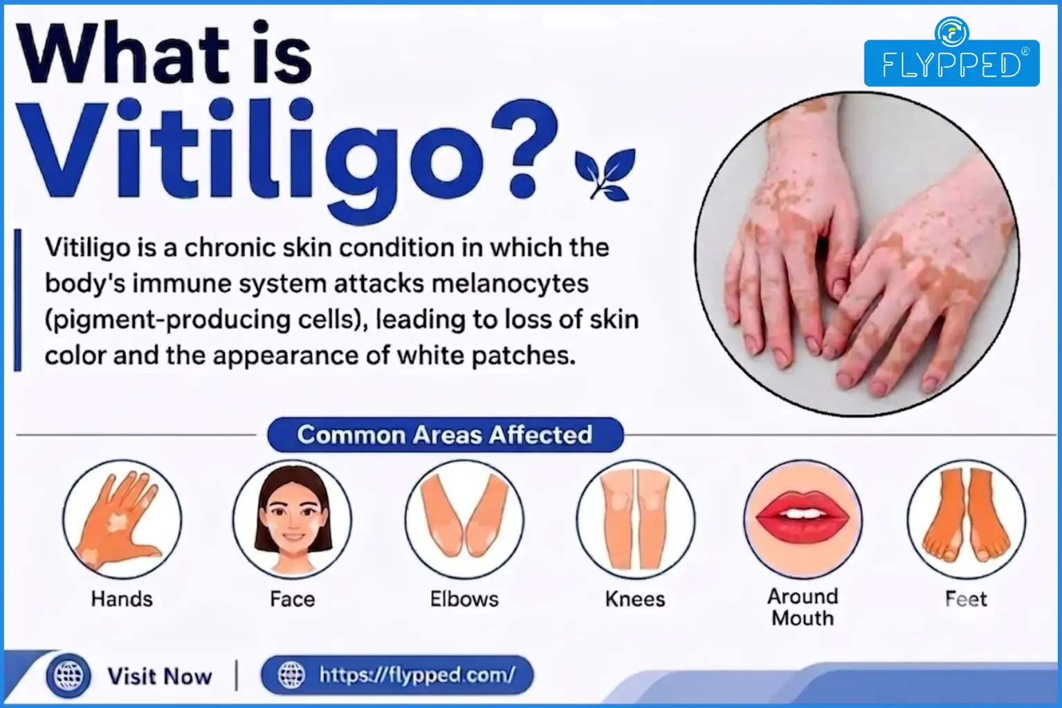 What is Vitiligo