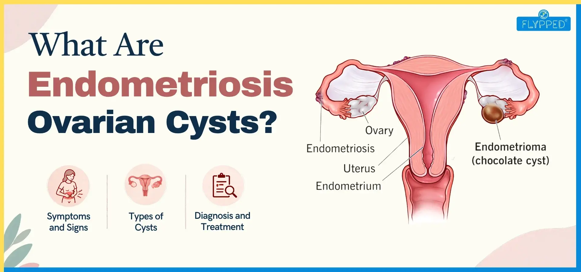 Endometriosis Ovarian Cyst: Symptoms, Pain Signs and Treatment