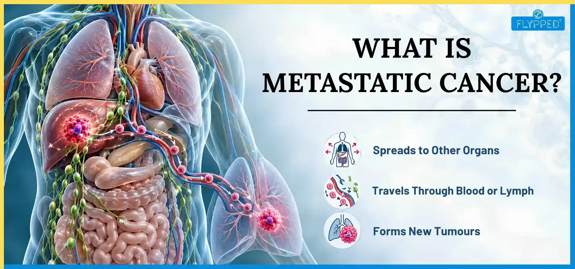 What is Metastatic Cancer? How It Spreads, Symptoms and Treatment