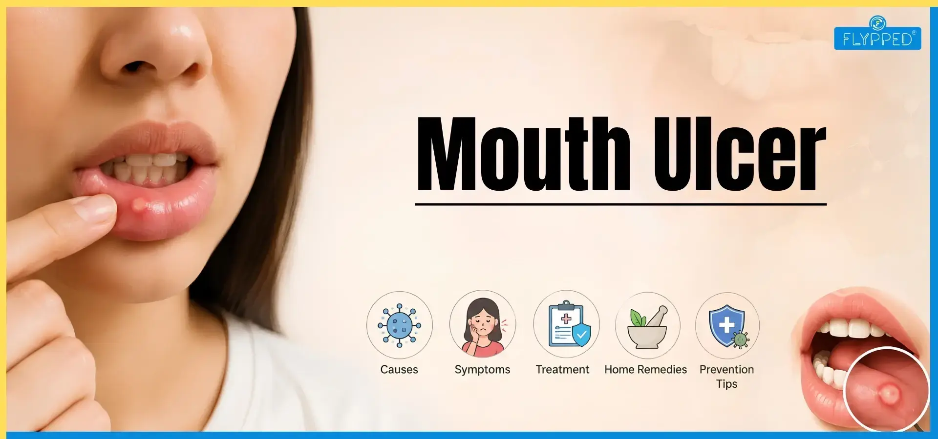 Mouth Ulcer: Causes, Symptoms, Treatment, Home Remedies and Prevention Tips